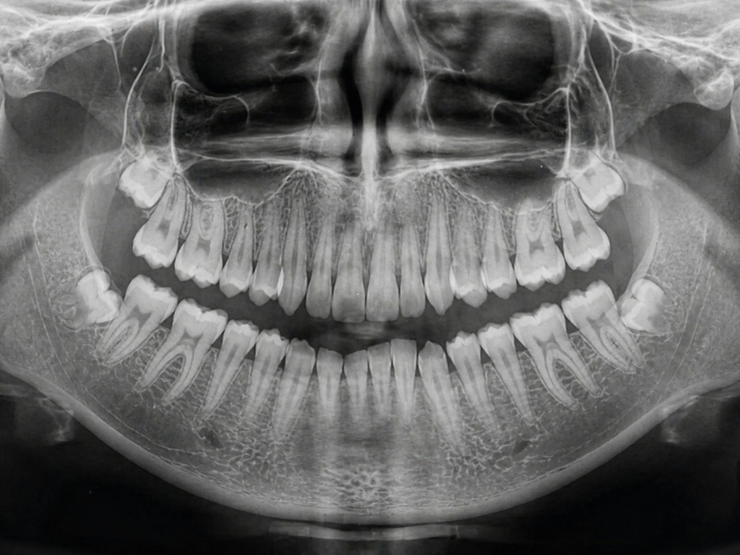 Third Molar (Wisdom) Removal Storyboard
