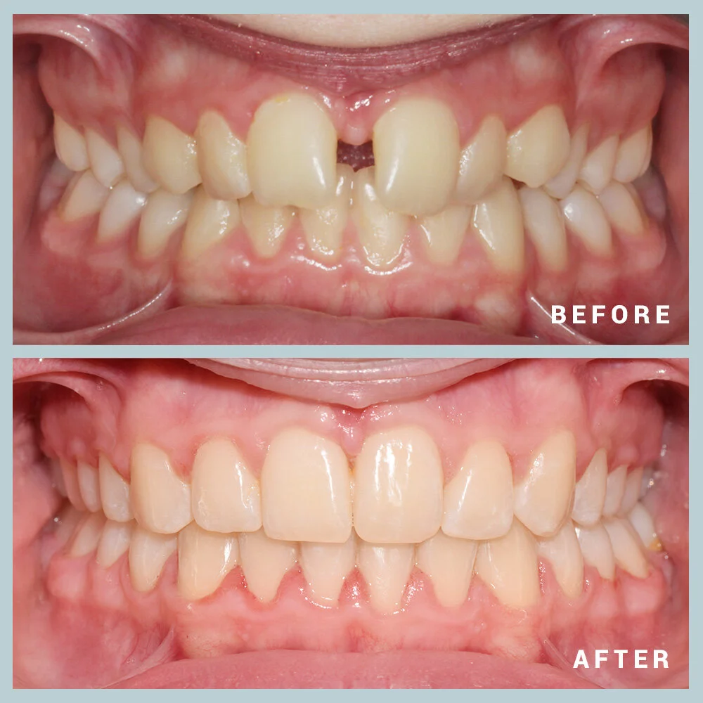 Orthodontics Before & After Orthodontics Results Foundations