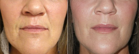 Before and after NLF Juvederm.jpg