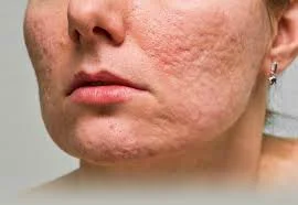 Acne Scarring
