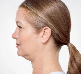 Double Chin Treatments