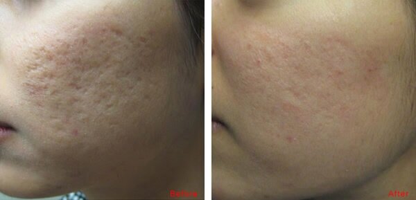 How Long After Co2 Laser Can I Do Microneedling?  