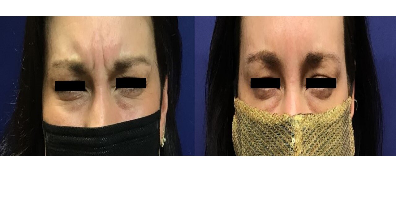 JH B&A Glabella.jpg