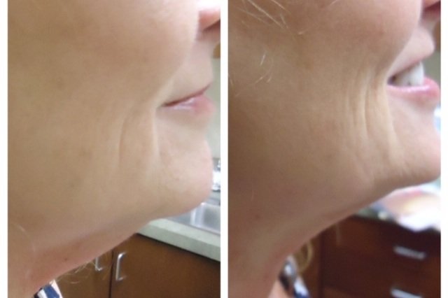 Before+after+Kybella.jpg