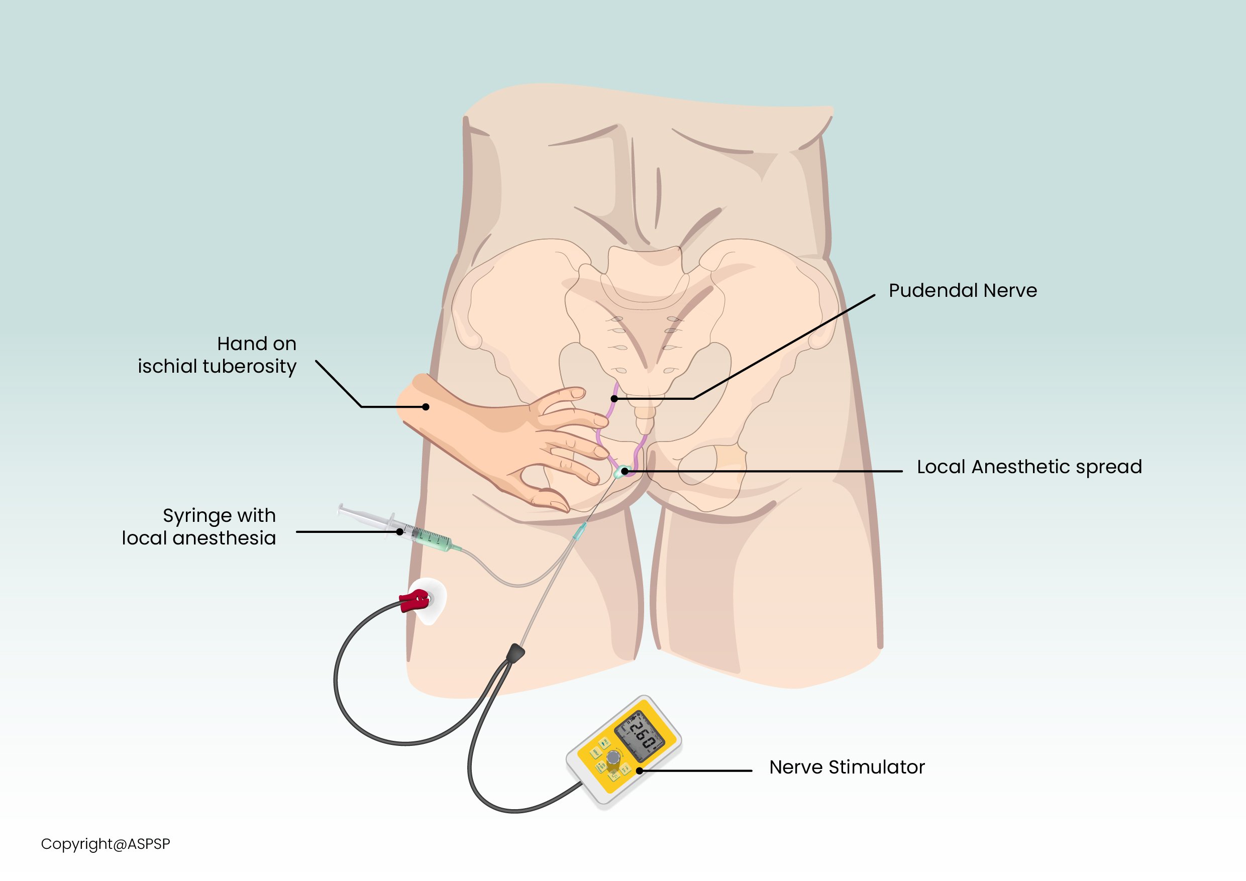 Pudendal nerve block illustration.jpg