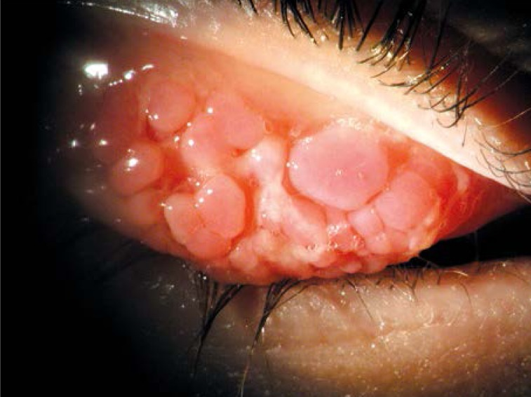 conjunctivitis-papillary-clinical-ophth-giant-original.png