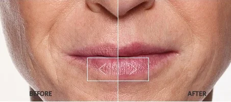 Restylane-before-after.jpg