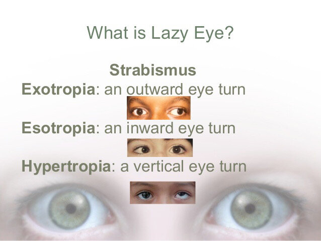 What Is Lazy Eye Eye Florida