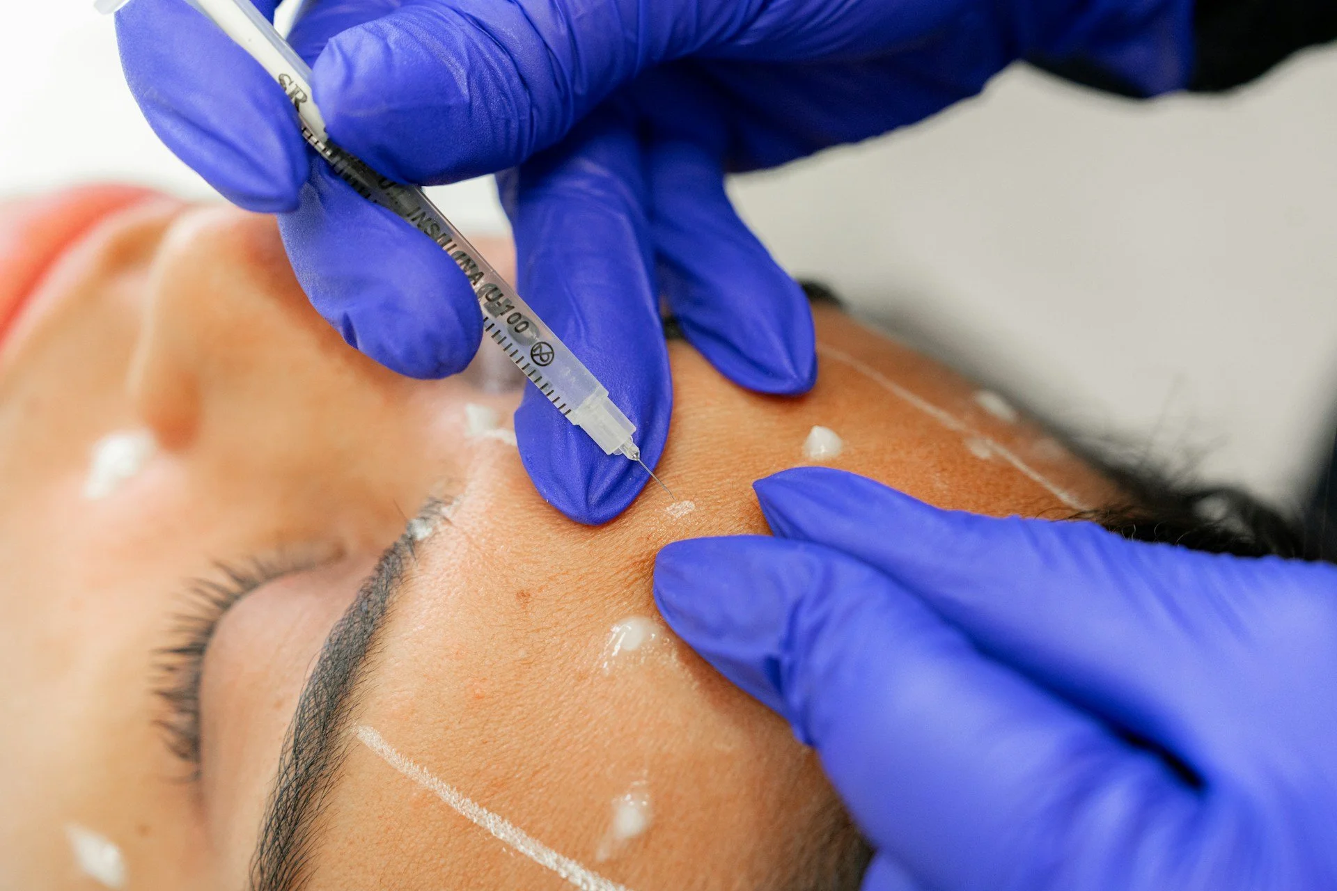 How Dermal Fillers Can Transform Your Appearance in Kissimmee