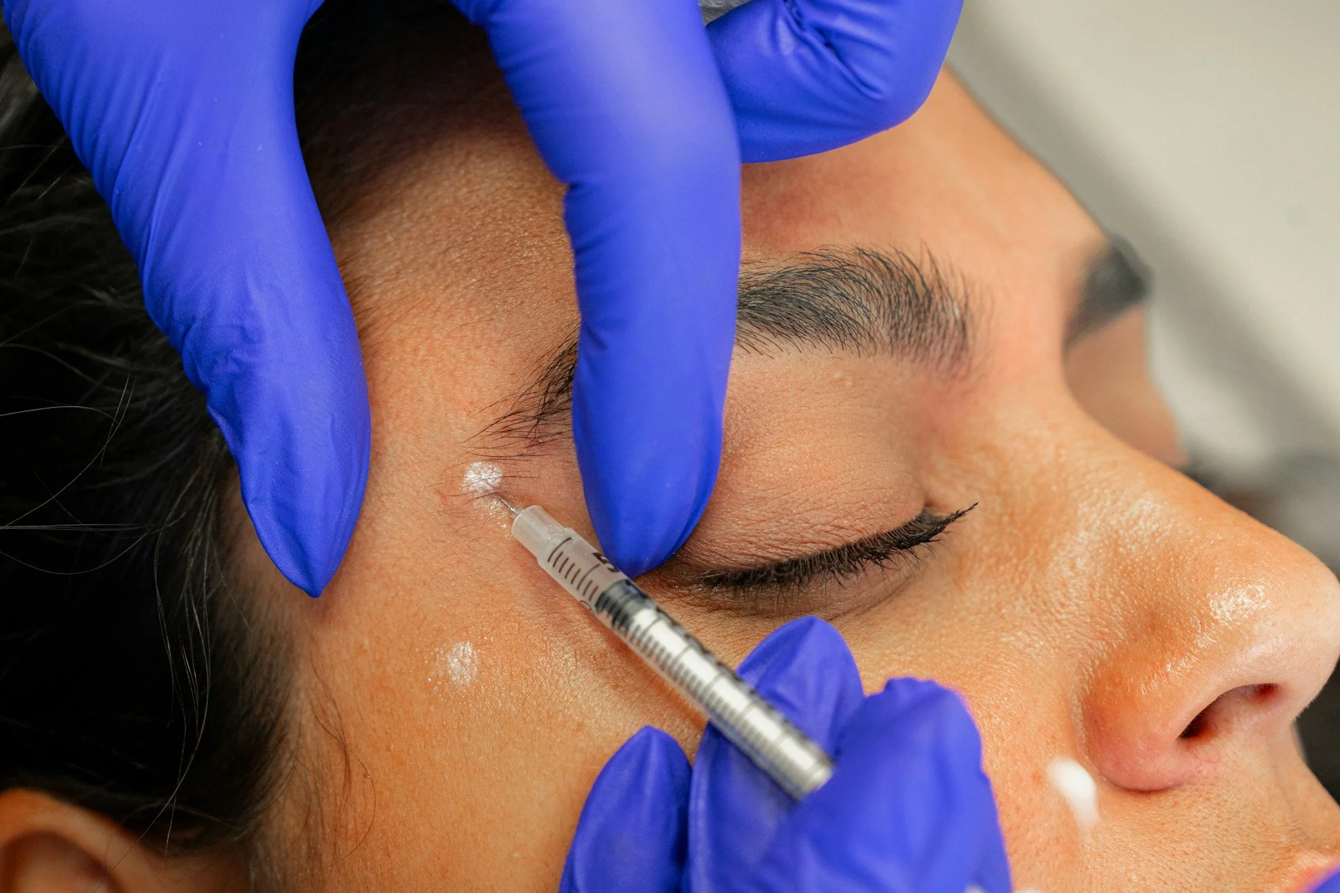 St Cloud Botox Tips for Smoother Skin by Spring Break