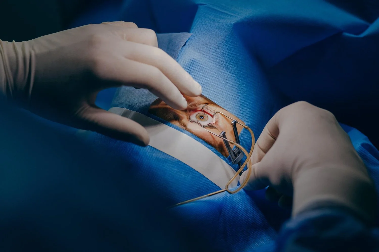 Common Cataract Surgery Myths in Central Florida Debunked