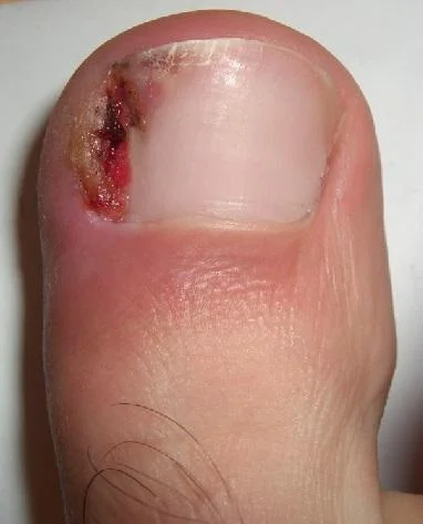 A very common picture of a very unhappy toenail.