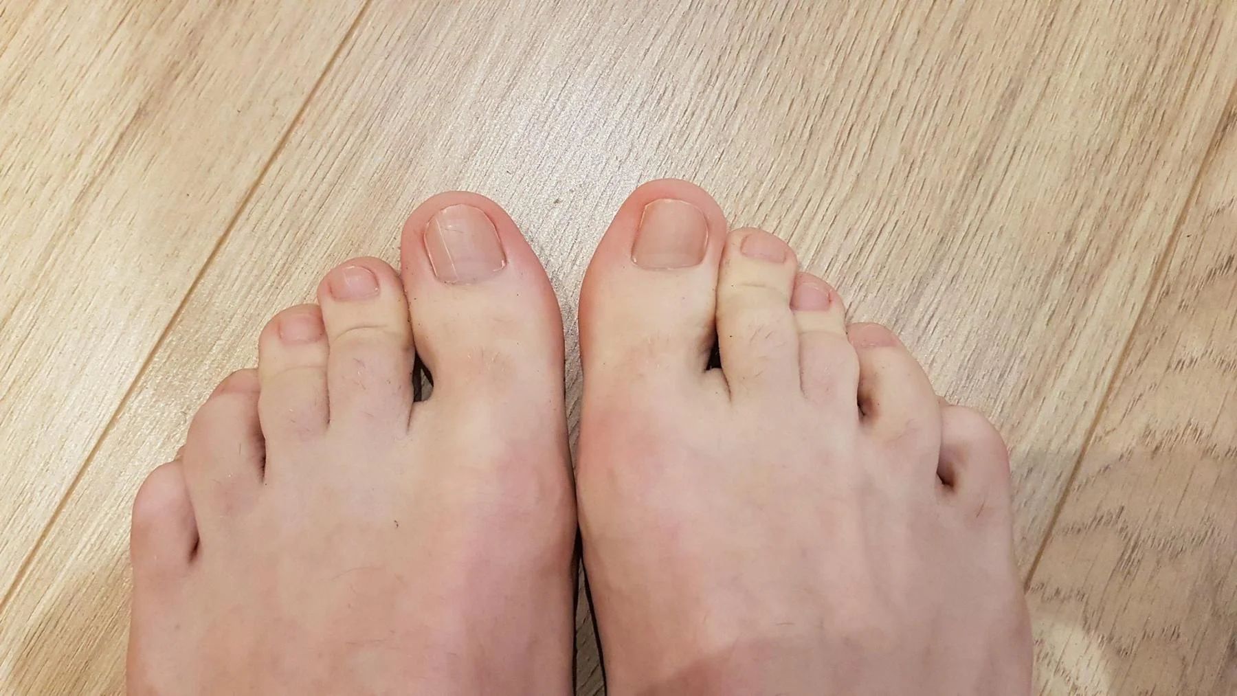 Four years post-procedure. Still good.