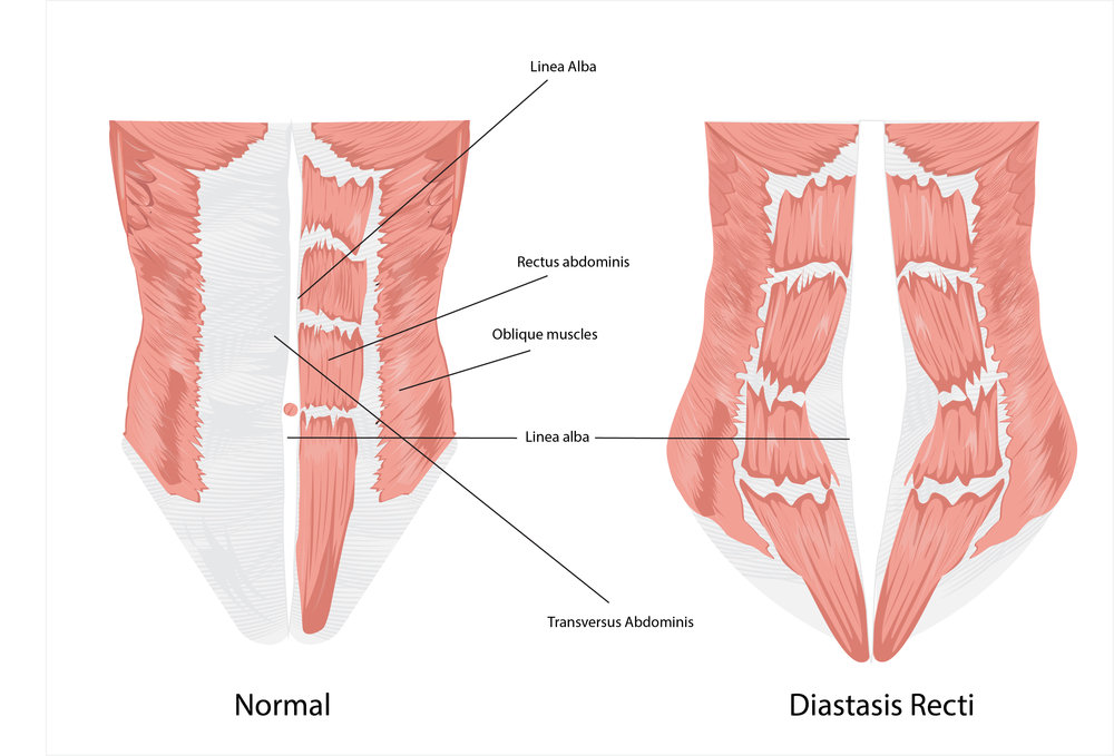 Diastasis recti: how do you know if you have it and what can you do about  it? — Brill Physical Therapy