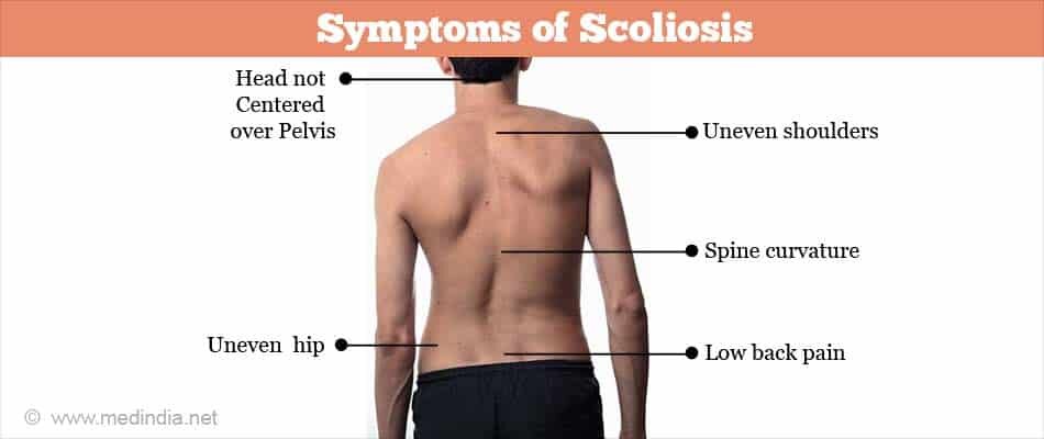 Schroth Scoliosis Physical Therapy — Brill Physical Therapy