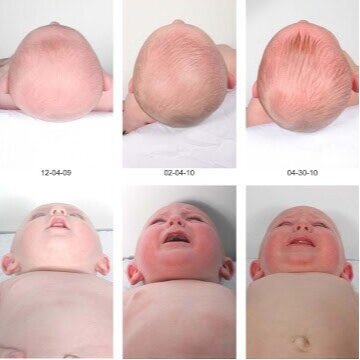 Plagiocephaly with hands on treatment over 5 months