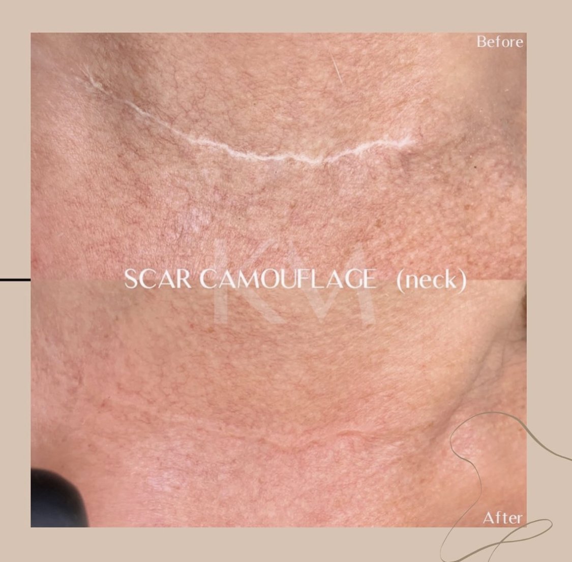 Scar Camouflage — Karina Michele
