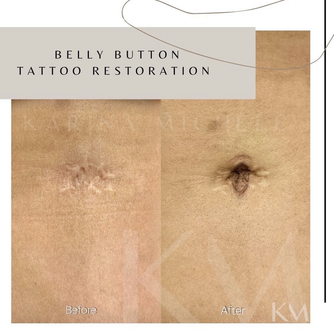 Skin Camouflage (Vitiligo, birth marks, etc.) - Camouflage Pigmentation -  Beauty Bar by Terri | Medical & Cosmetic Tattoo Services in Plano