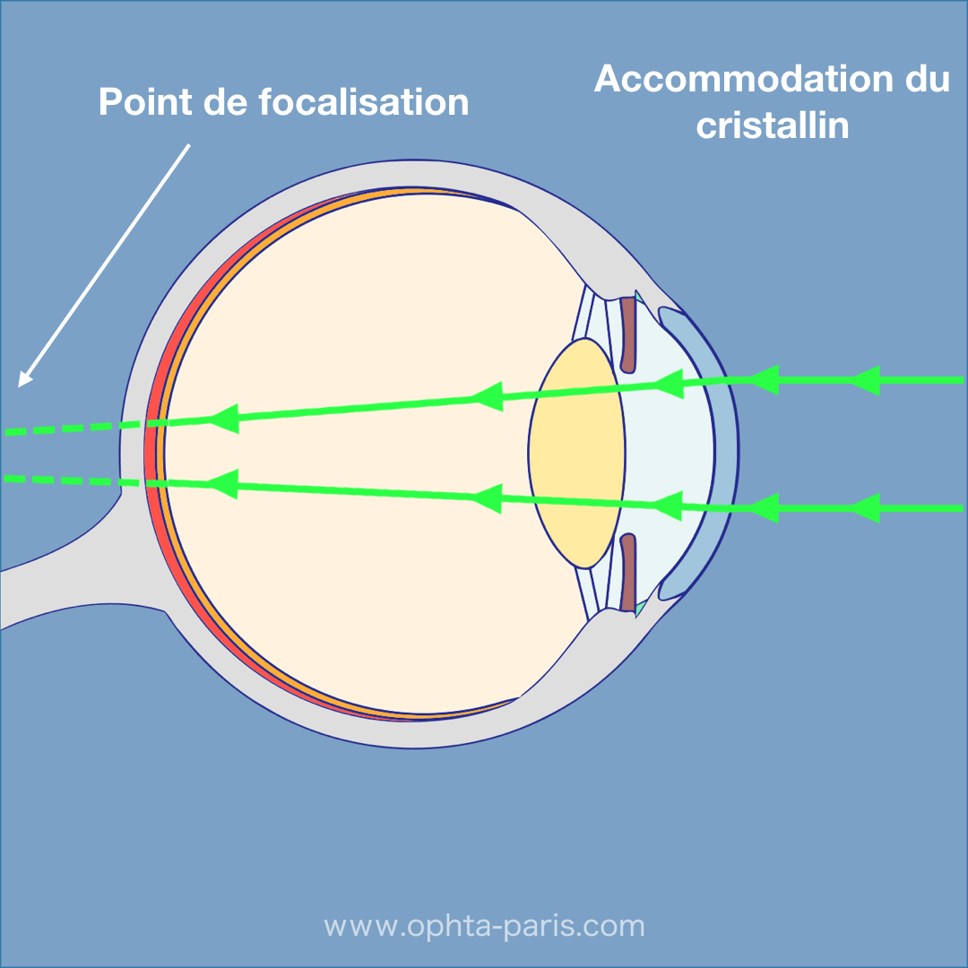Avec L âge Le Pouvoir D accommodation Du Cristallin Diminue Schémas