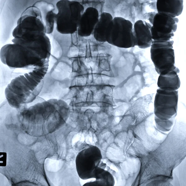 Fluoroscopy
