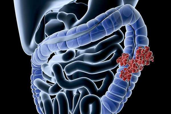 Colorectal Cancer Screening.jpg