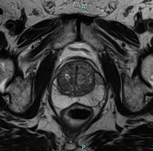 What To Expect During MRI Screening for Prostate Cancer