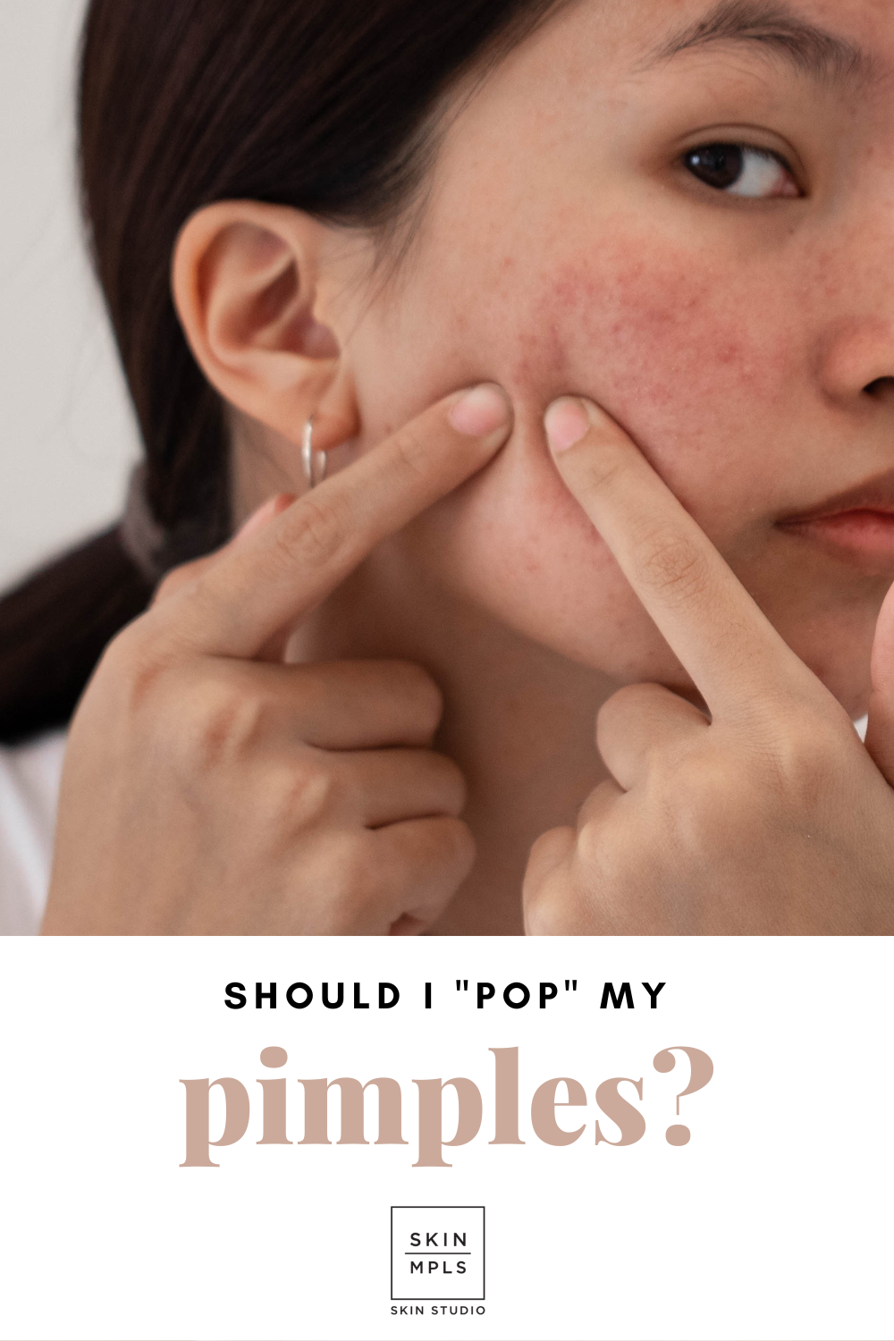 Should I "Pop" My Pimples? 