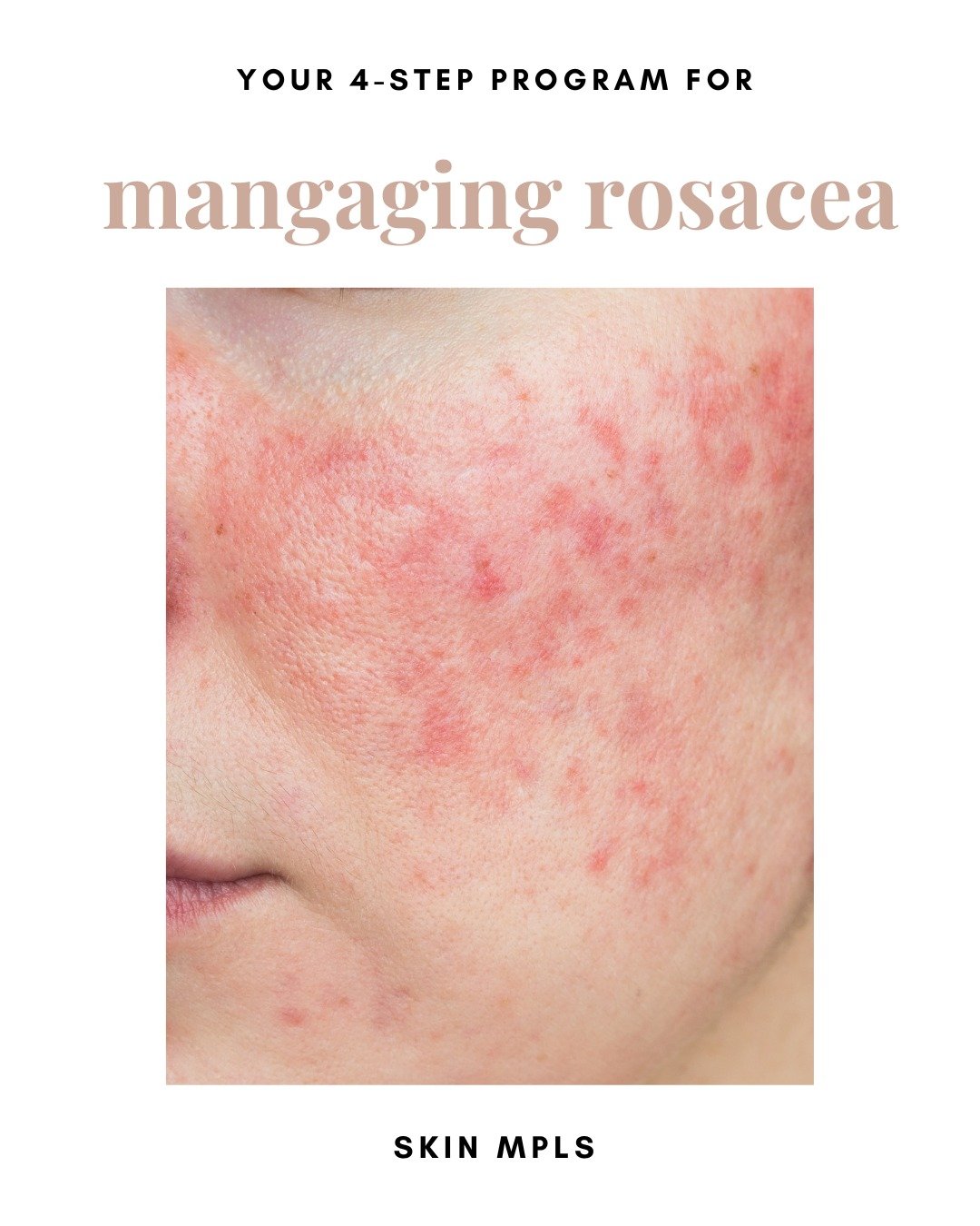 Our number one goal at #SKINMPLS is to help everyone feel confident in their skin, especially when it comes to dealing with rosacea! 

Like acne, rosacea has no cure but adopting a treatment plan and a targeted skincare regimen can help your symptoms
