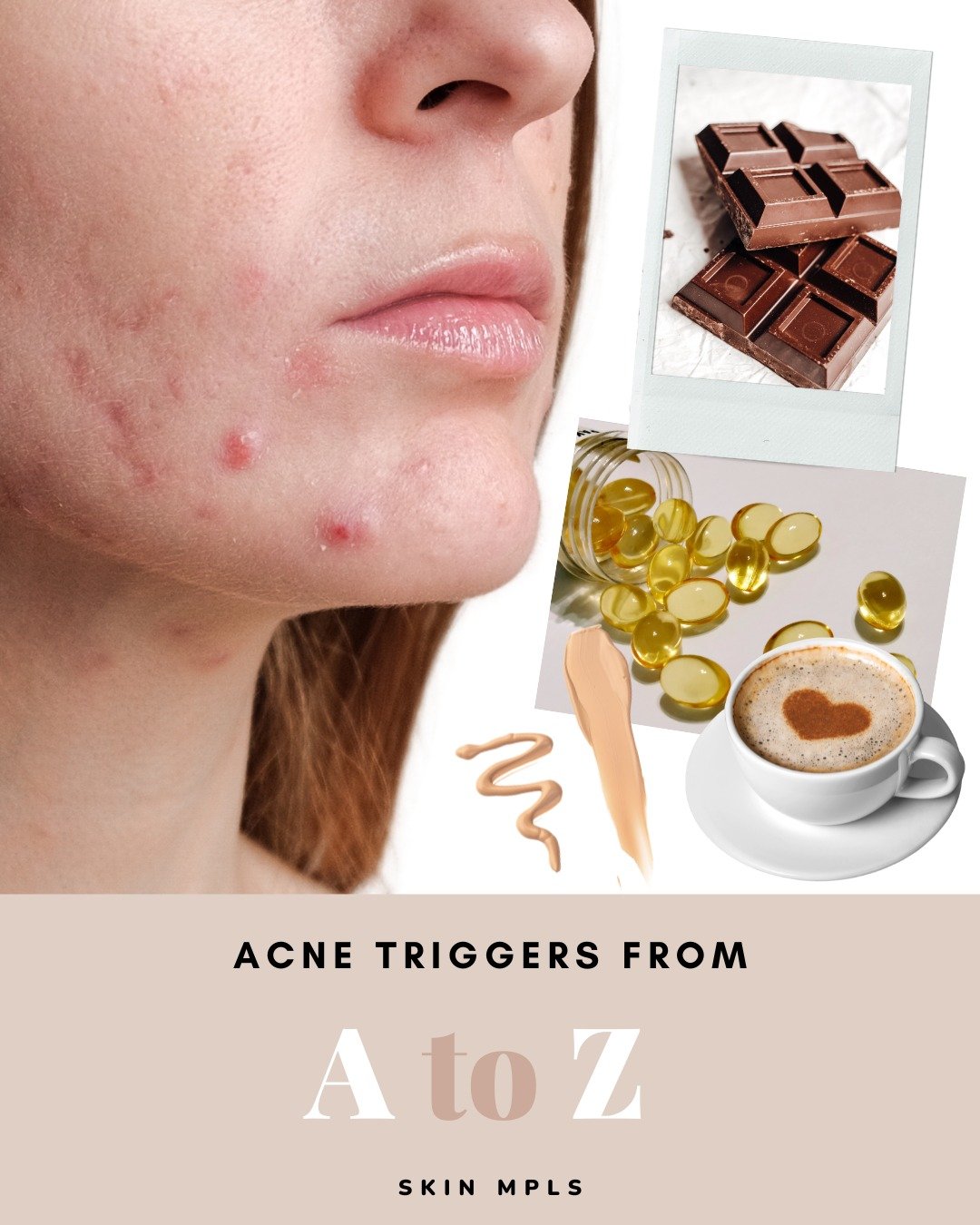 As we mentioned in our post yesterday, internal and external things can trigger acne, from inflammatory foods to pore-cloggers&mdash;the list can go on and on! But have no fear; we at #SKINMPLS have made a list of things to watch out for. 

Remember,