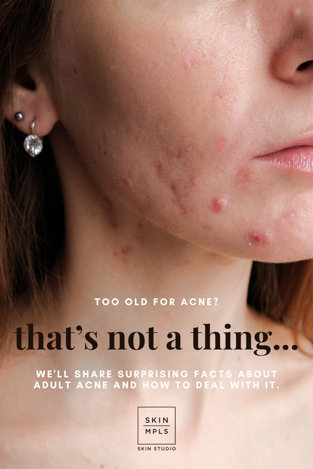 Too Old For Acne? That's Not a Thing…