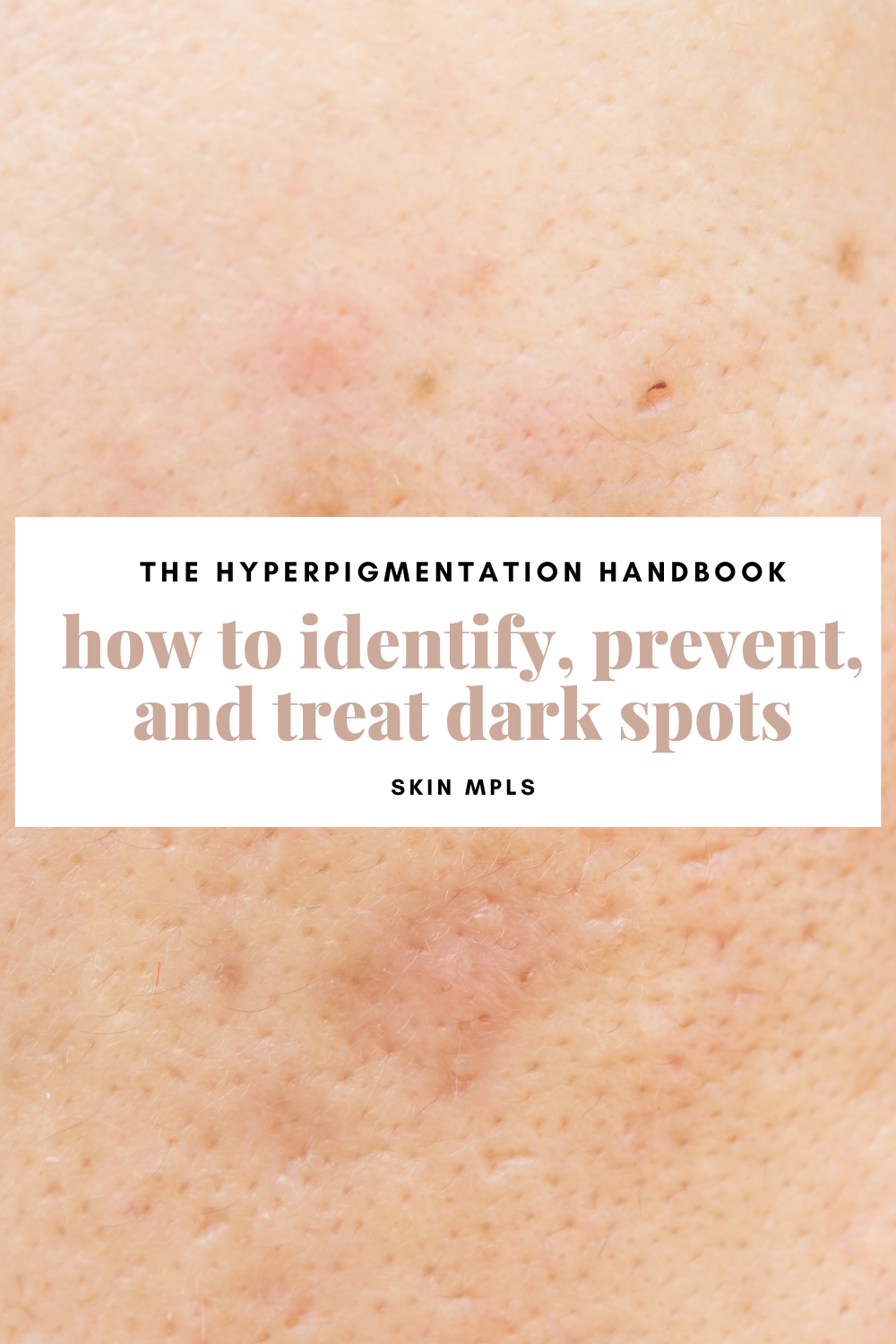 The Hyperpigmentation Handbook