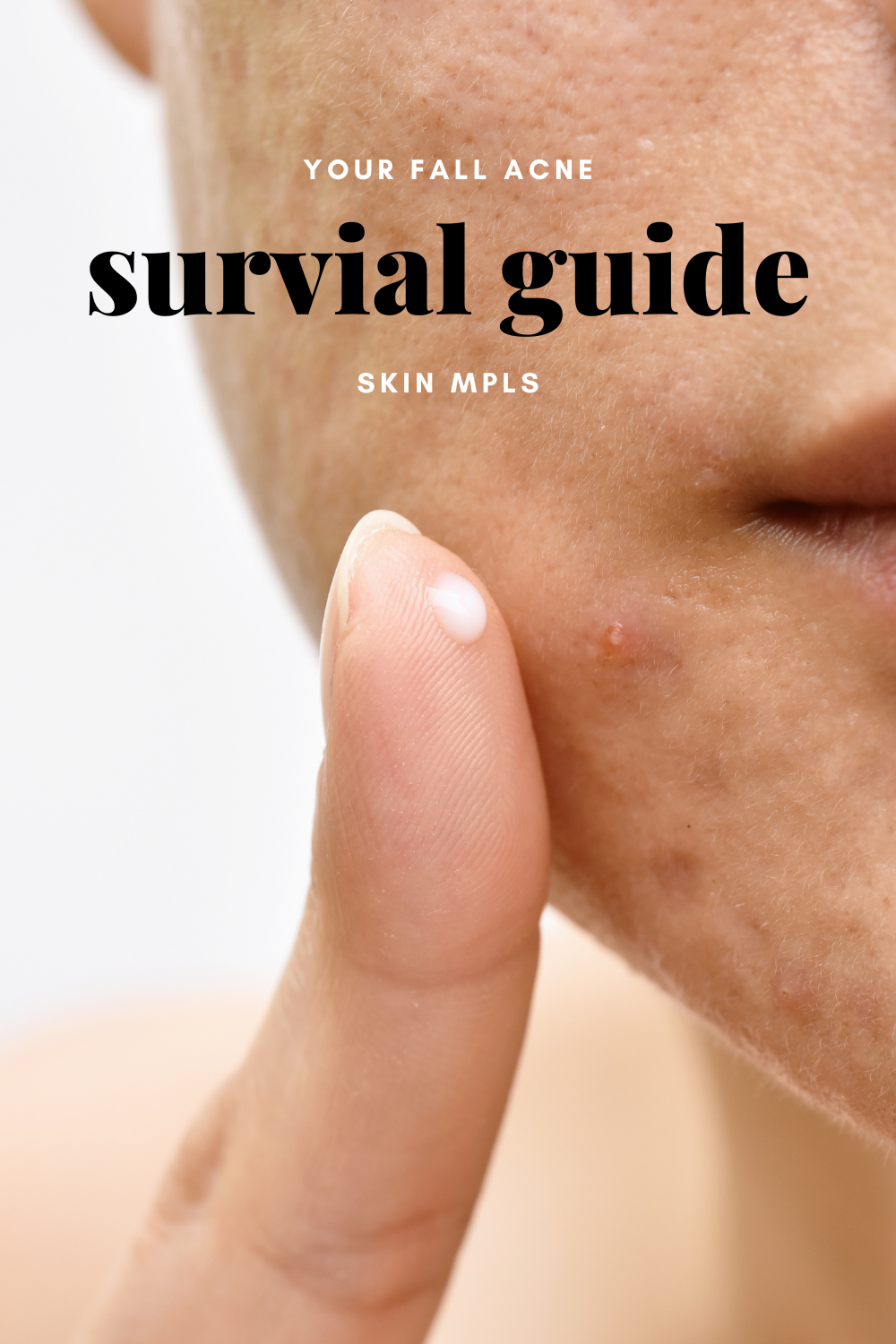 Your Fall Acne Survival Guide