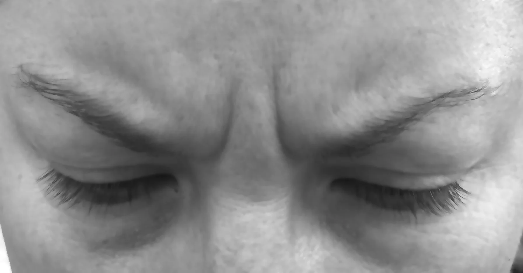 F.B.S.~Furrowed Brow Syndrome