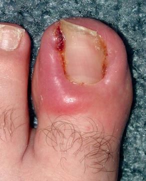 Ingrown Toenail