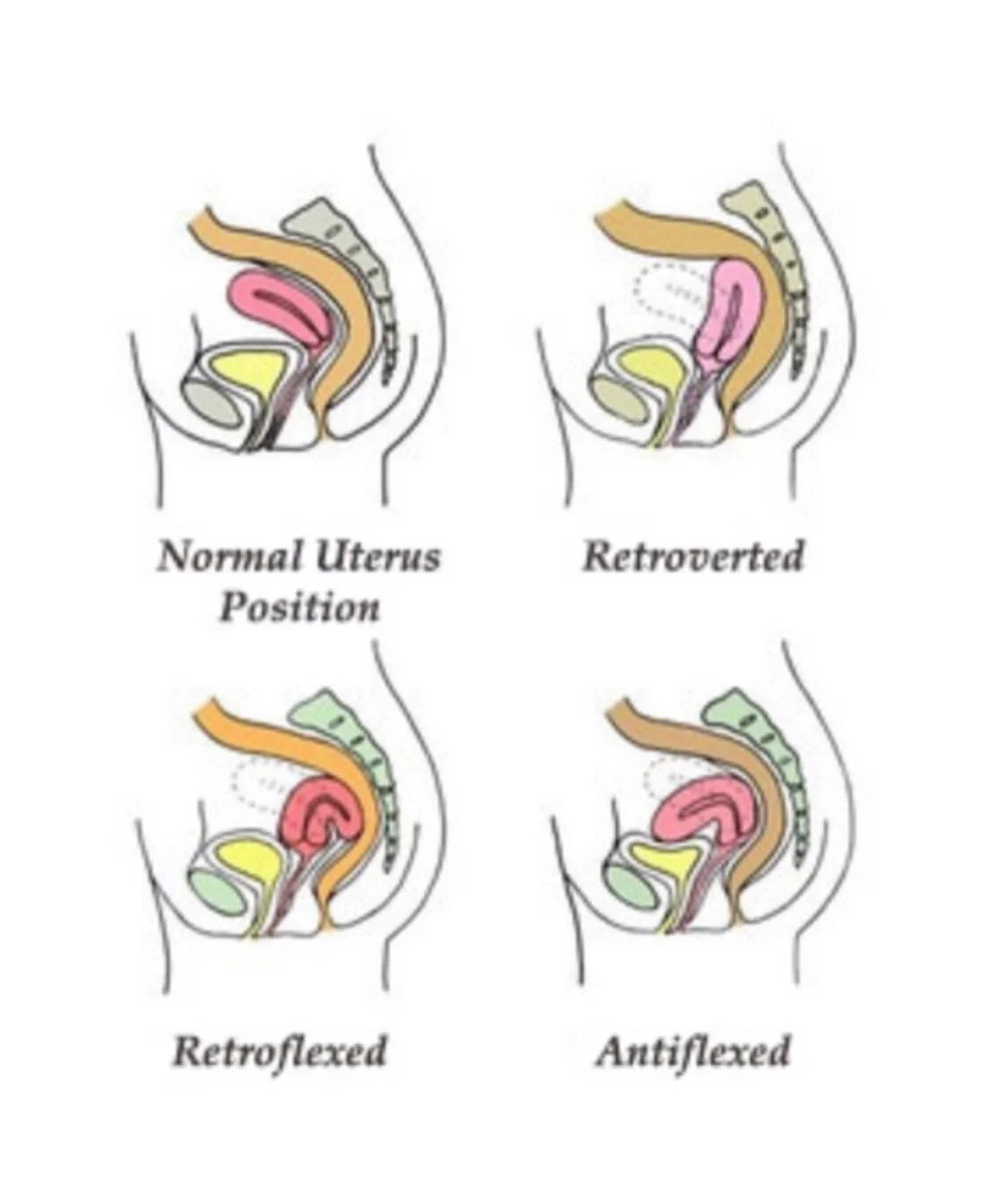 Signs of a Misaligned Uterus