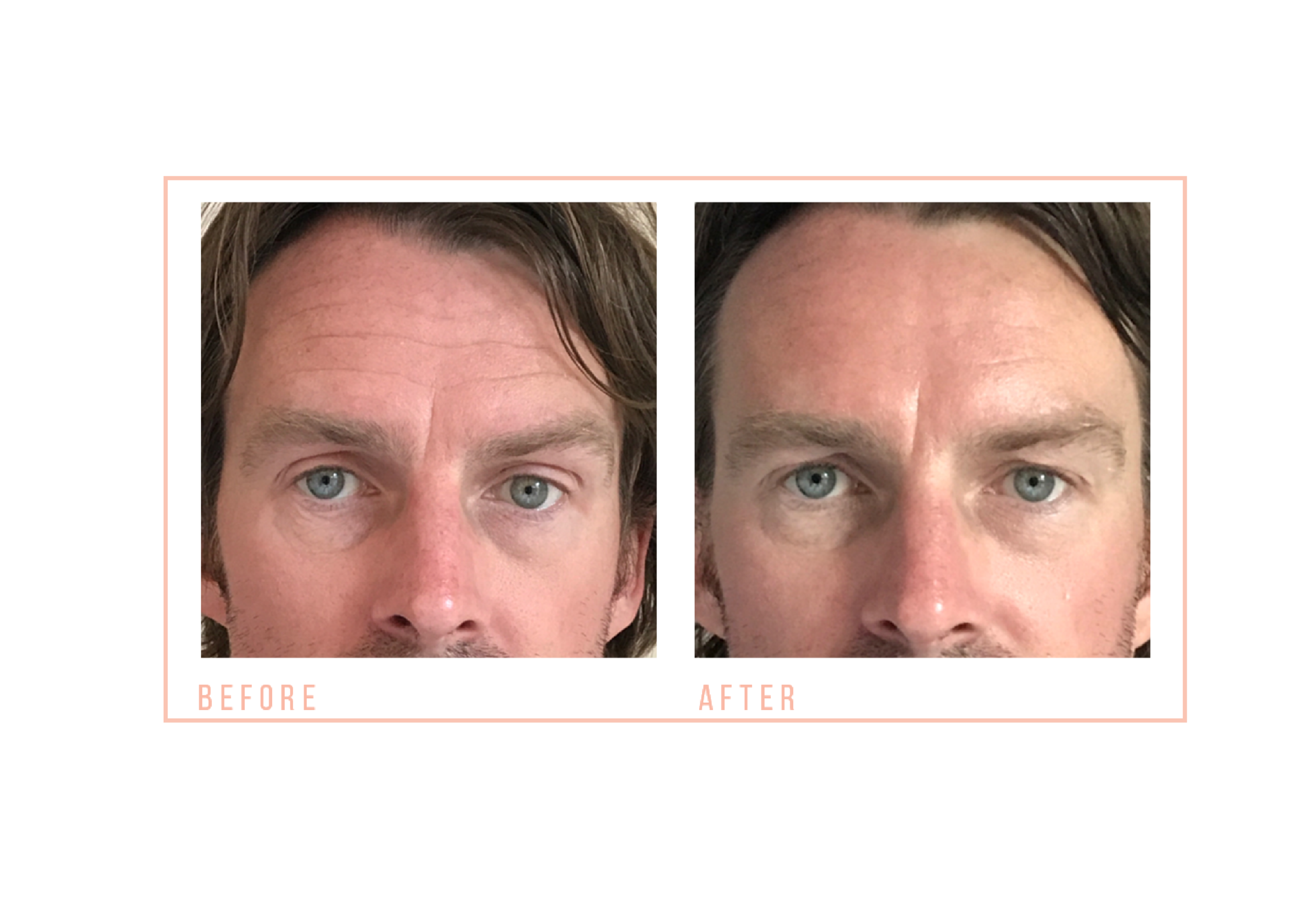 Male Non-Surgical Facial Toning Before and After.png