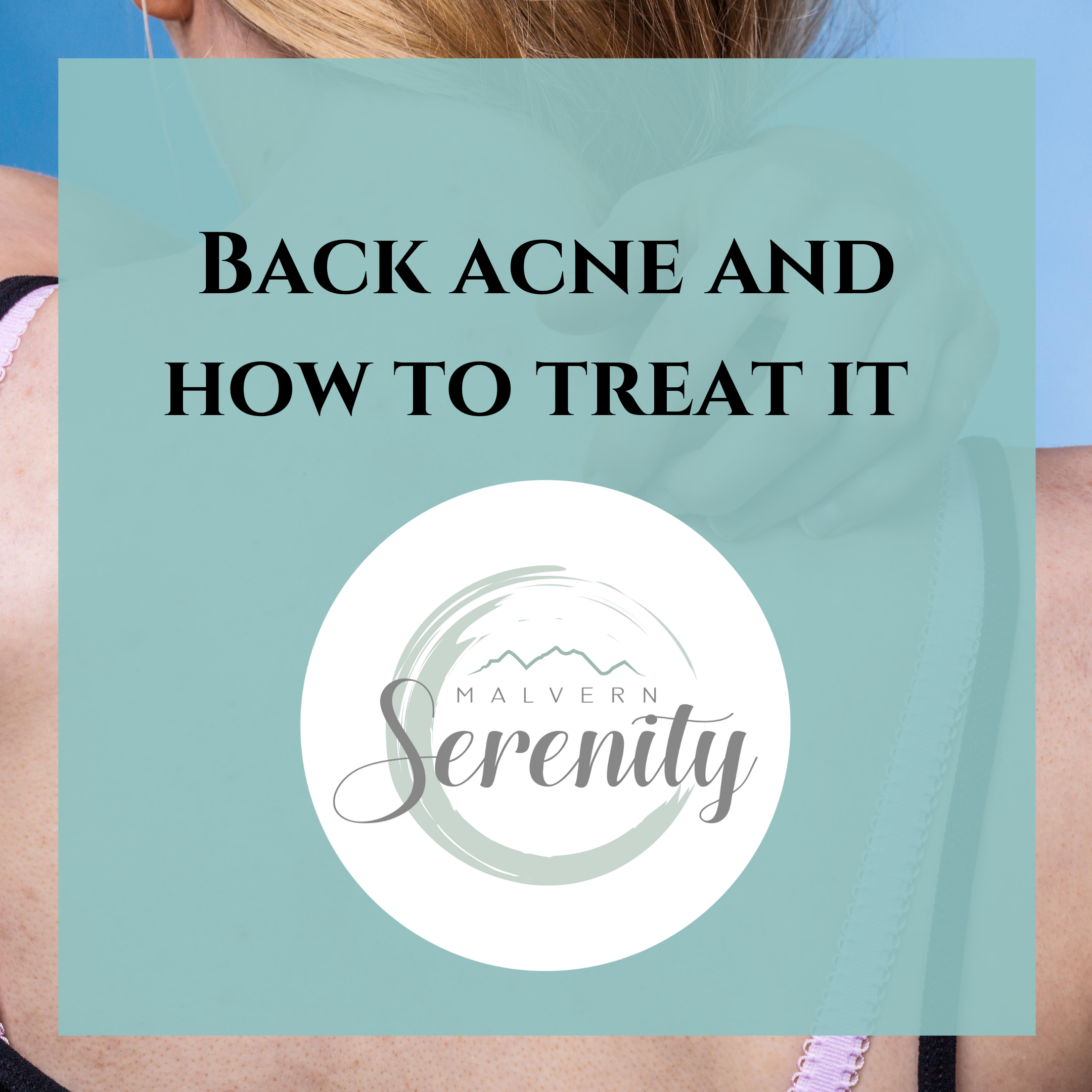 Back Acne and how to treat it 