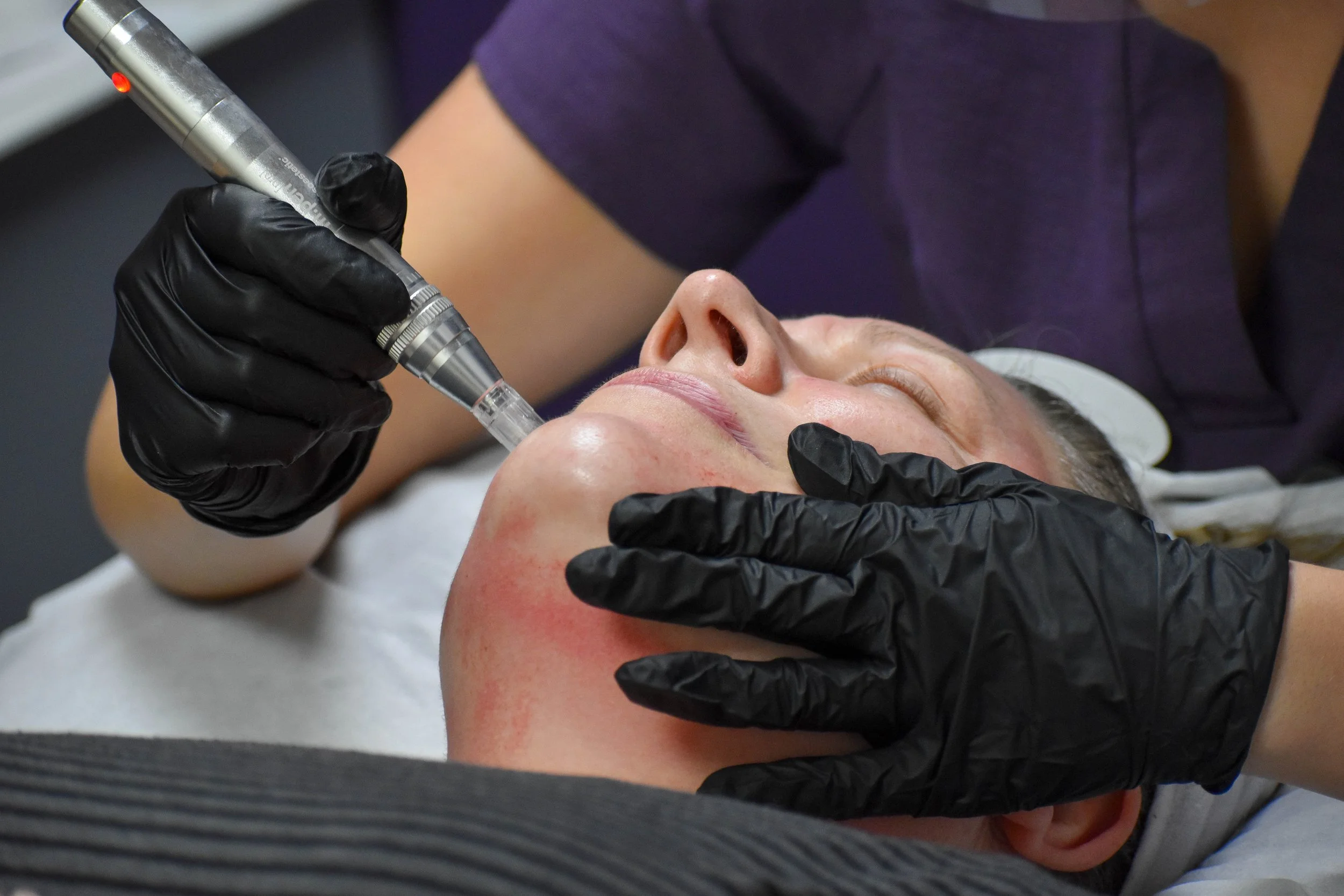 Transform Your Skin Naturally with Microneedling at Malvern Serenity