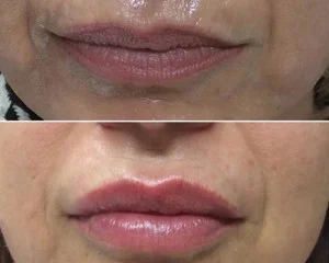 dermal1-300x240.jpg