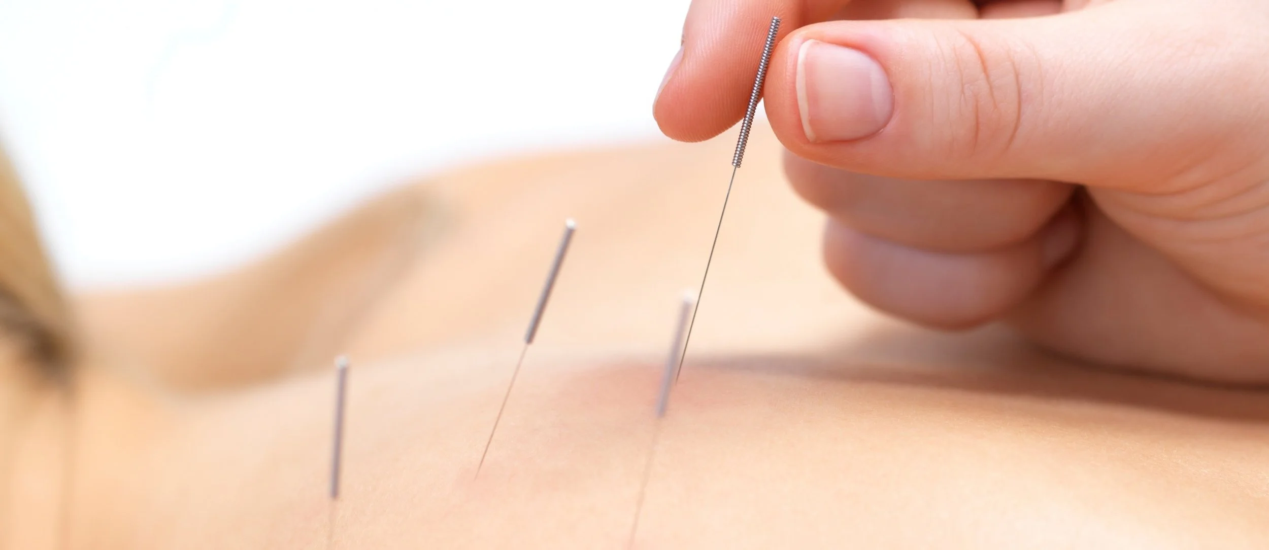 dry-needling-.jpg