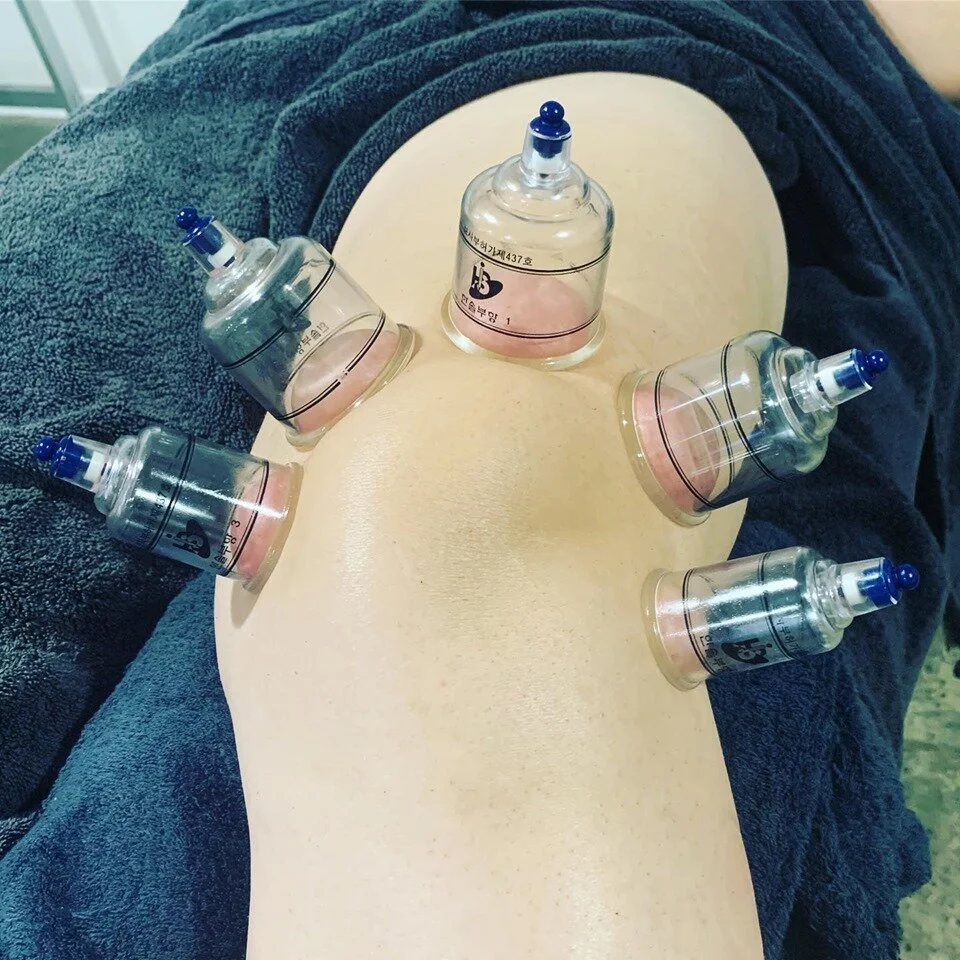 Myofascial Cupping of the knee