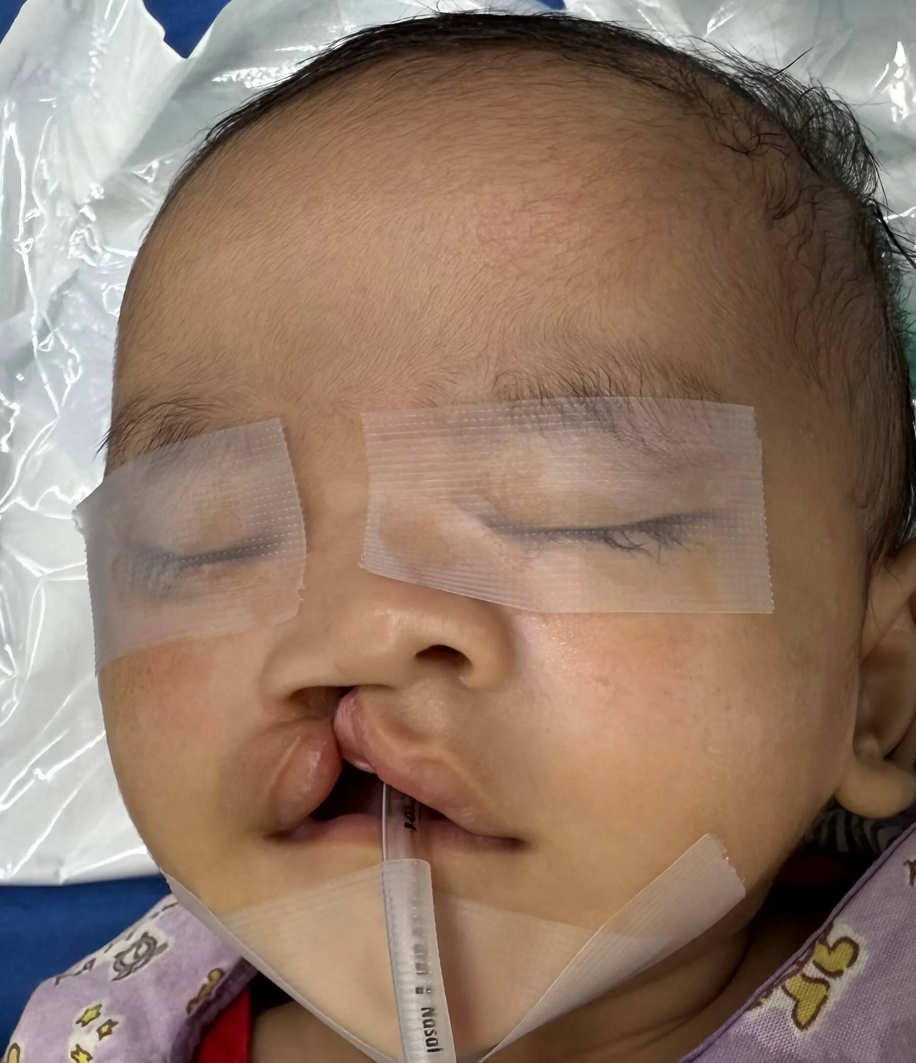 Before cleft lip surgery