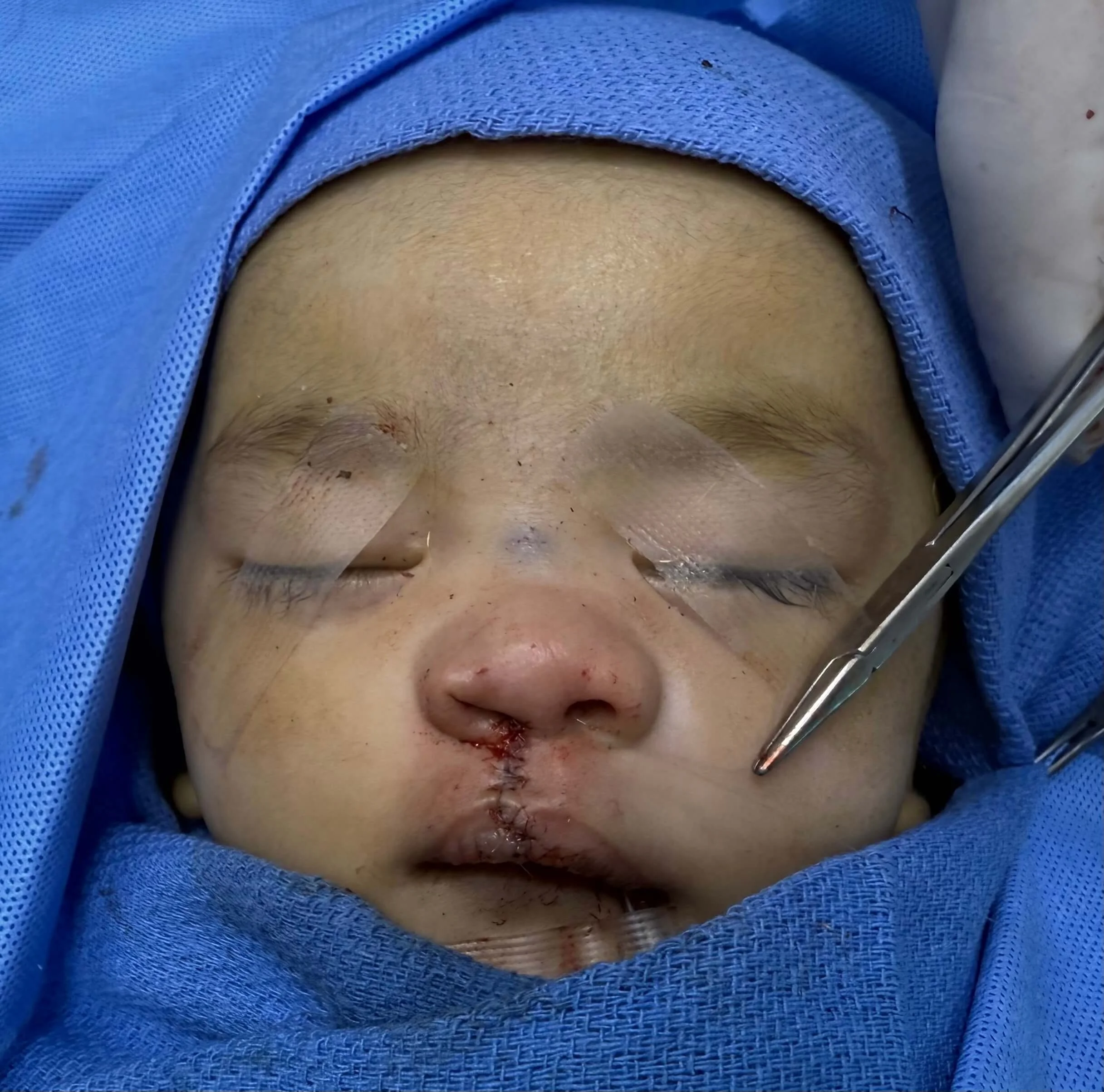 After cleft lip repair