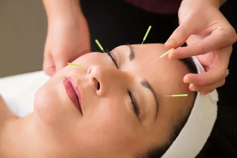 facial-acupuncture.jpeg
