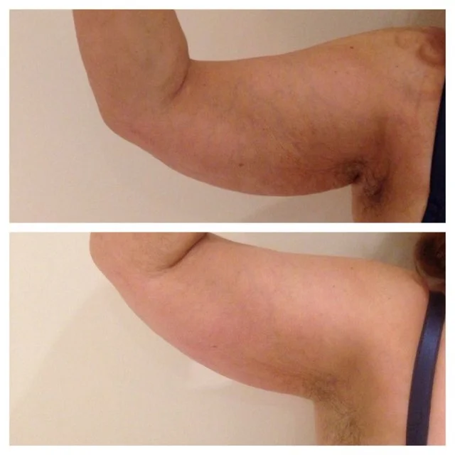 Arm Slimming Results.jpg