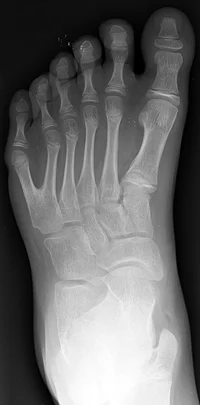 Foot with six toes