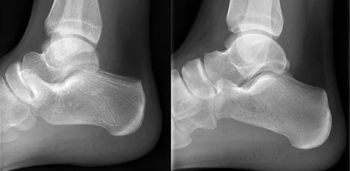 Tarsal Coalition – Before & After