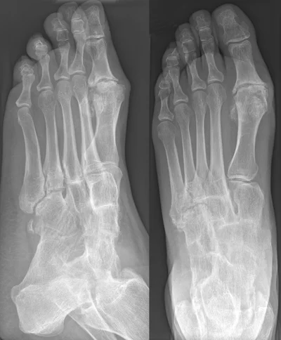 Ankle Arthritis