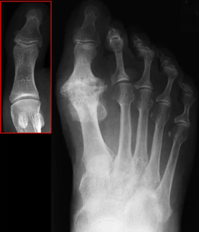 Big Toe Joint Arthritis