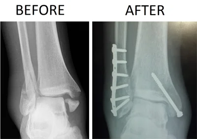 Ankle Fracture Surgery
